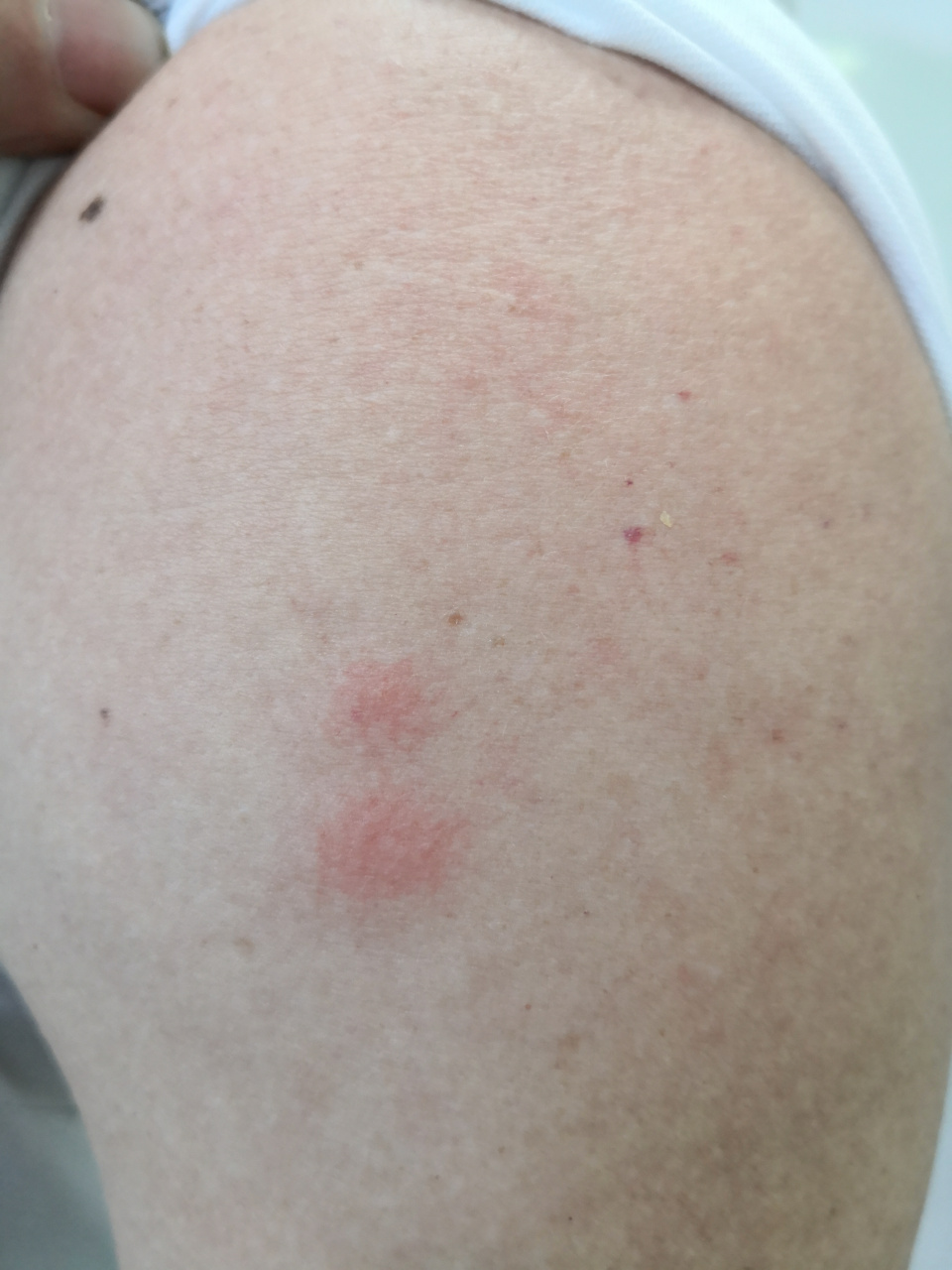 草丛里的蚊虫叮咬导致的虫咬皮炎症状#解决皮肤问题专注皮肤美容##丘