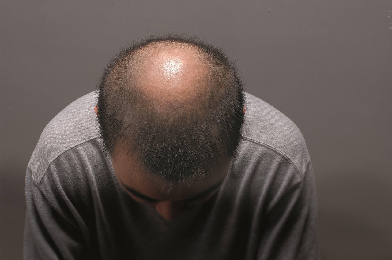 地中海式发型是很多程序员不能言说的痛,为什么程序员容易脱发?