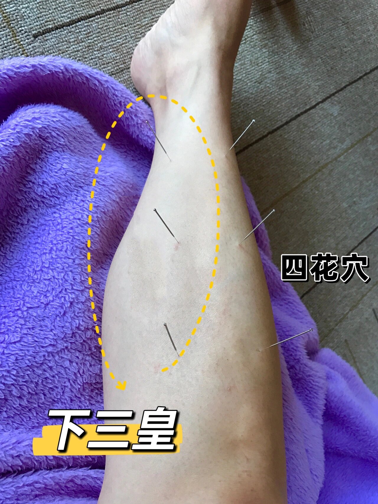 识穴第35篇|【下三皇】肾炎,四肢浮肿,男科 【董氏针灸·下三皇】 阳w