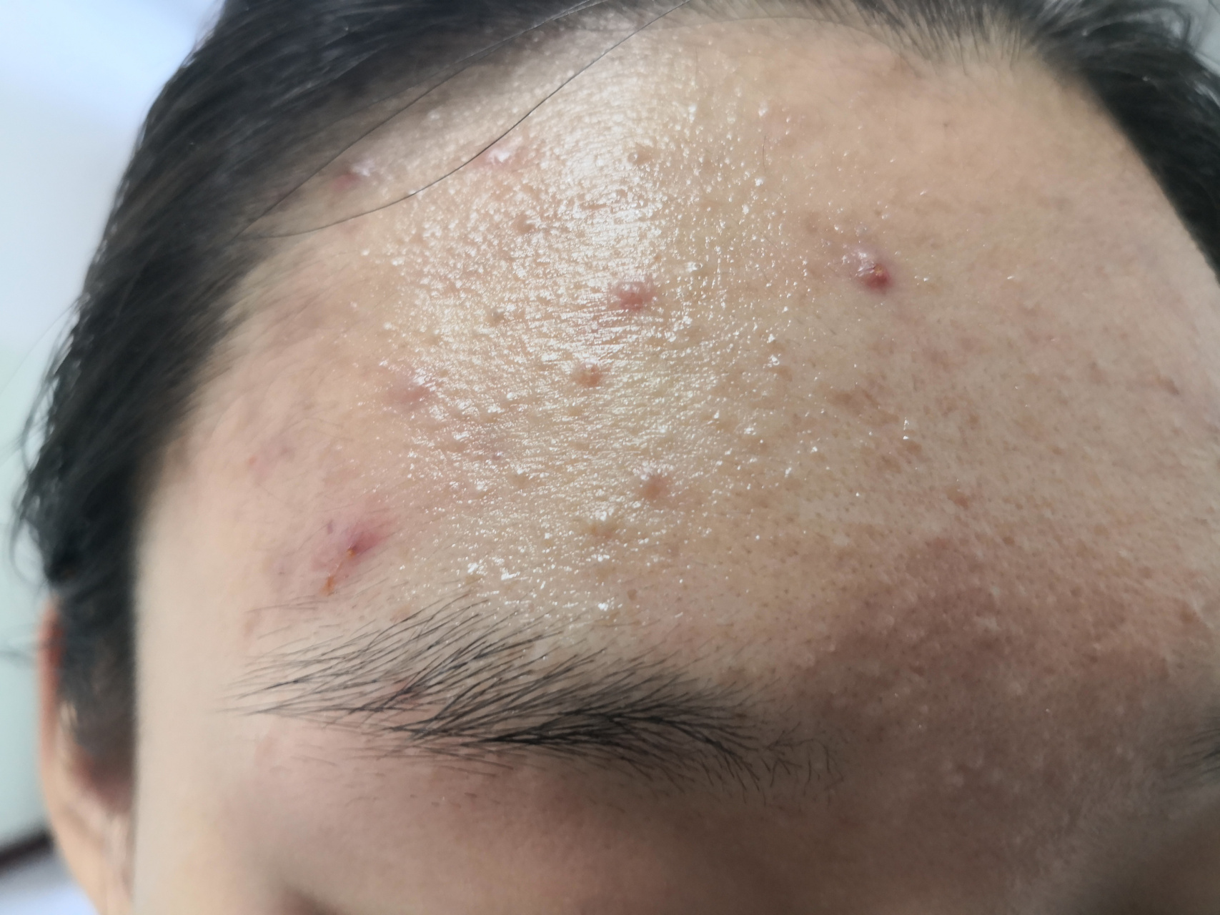 注意饮食清淡作息规律心平气和!#解决皮肤问题专注皮肤美容##痤疮