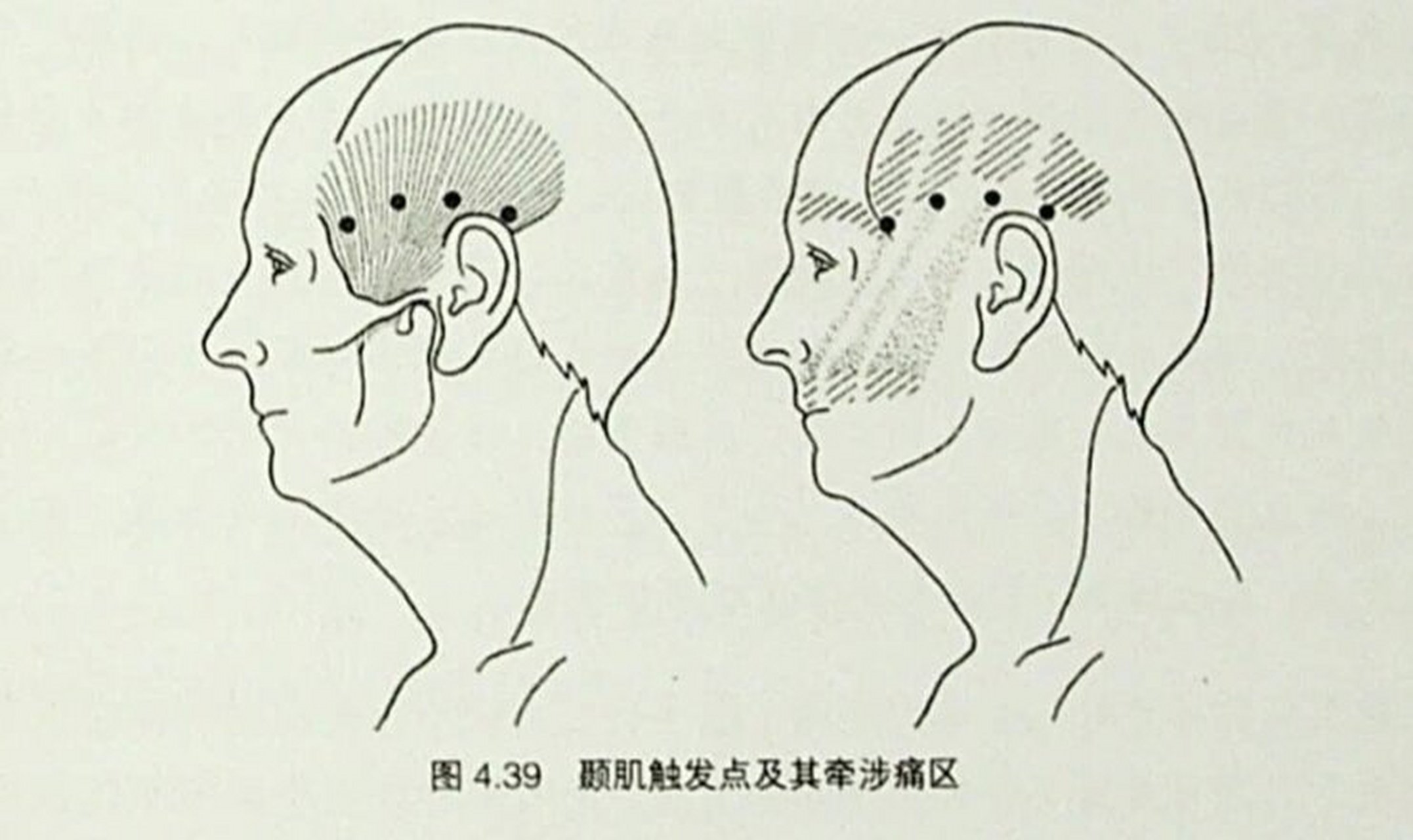 颞肌越来越大图片