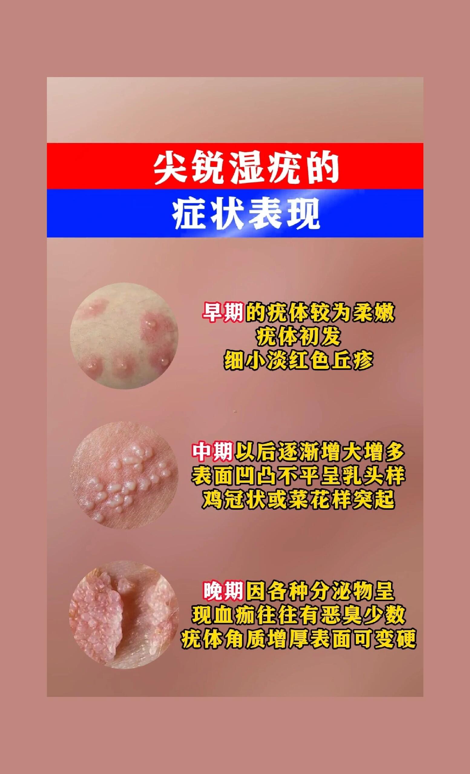 hpv感染尖锐湿疣症状表现