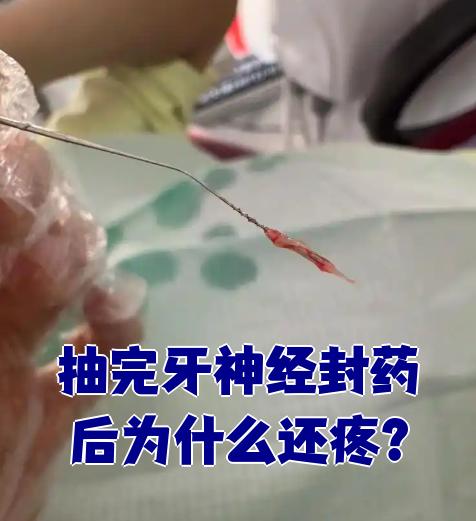 牙取完神经为什么还疼