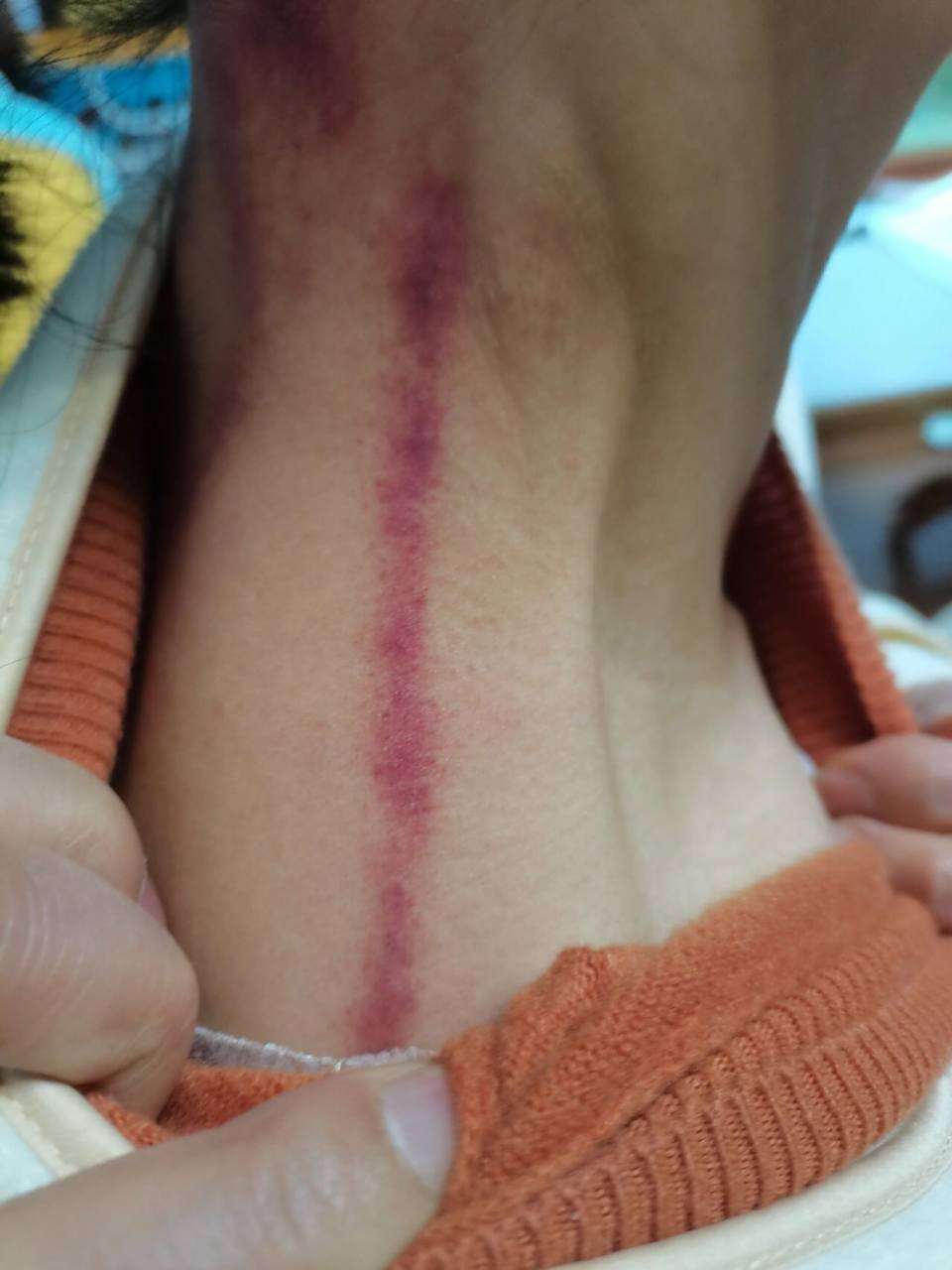 头重重的,脖子胀,让老公揪痧试试,结果不一会儿出痧了,还摸到一个泡