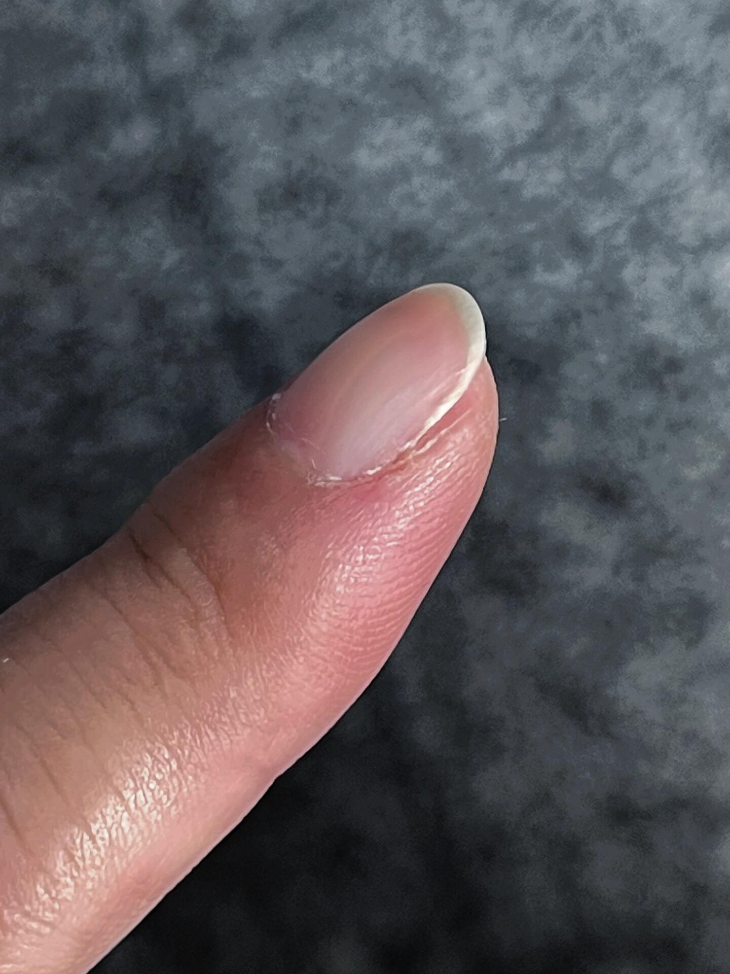 这些年越来越往下了,感觉哪天指甲会彻底跟肉分开了.