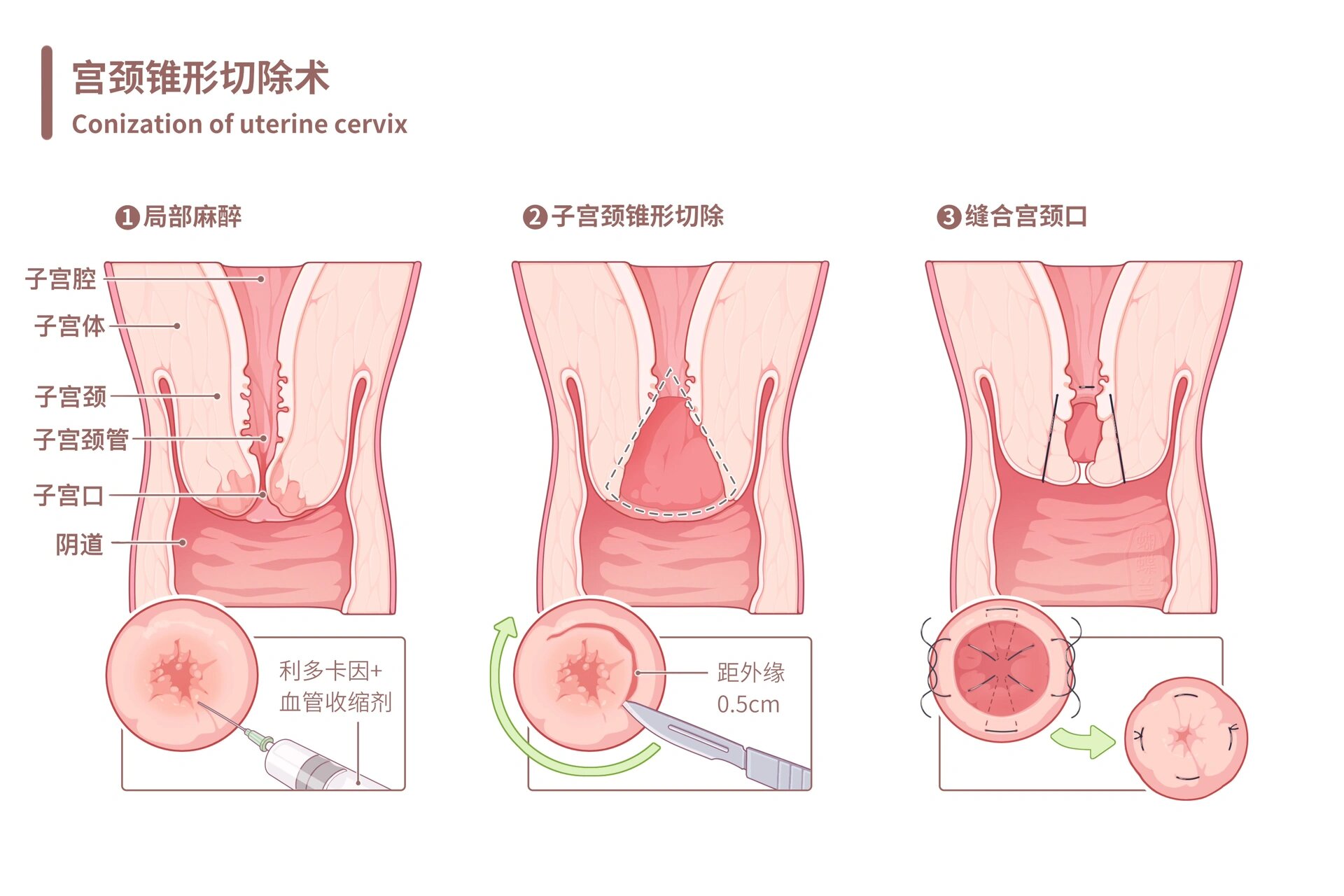 宫颈锥切图片示意图图片