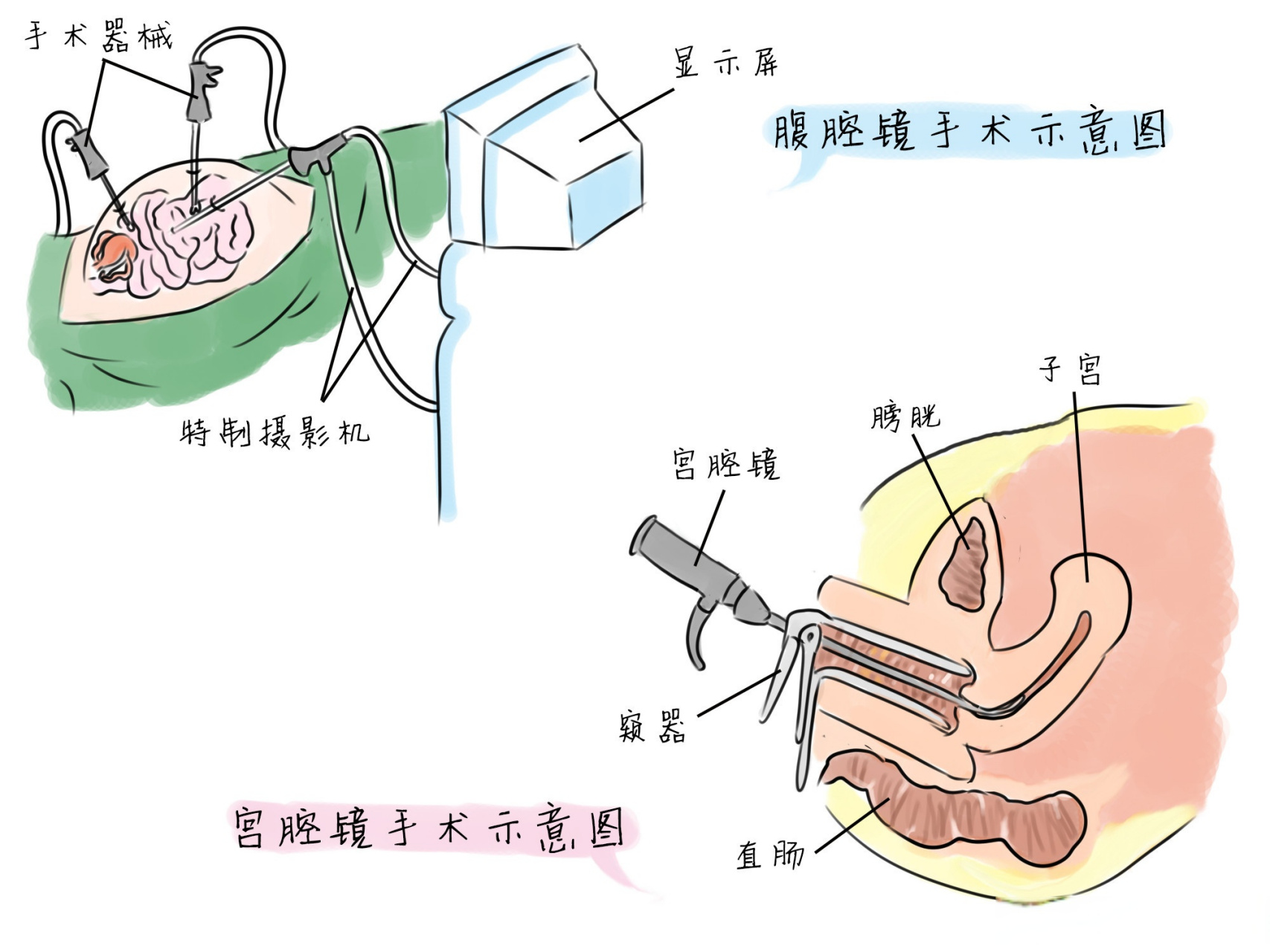 腹腔镜vs宫腔镜子宫肌瘤剔除术