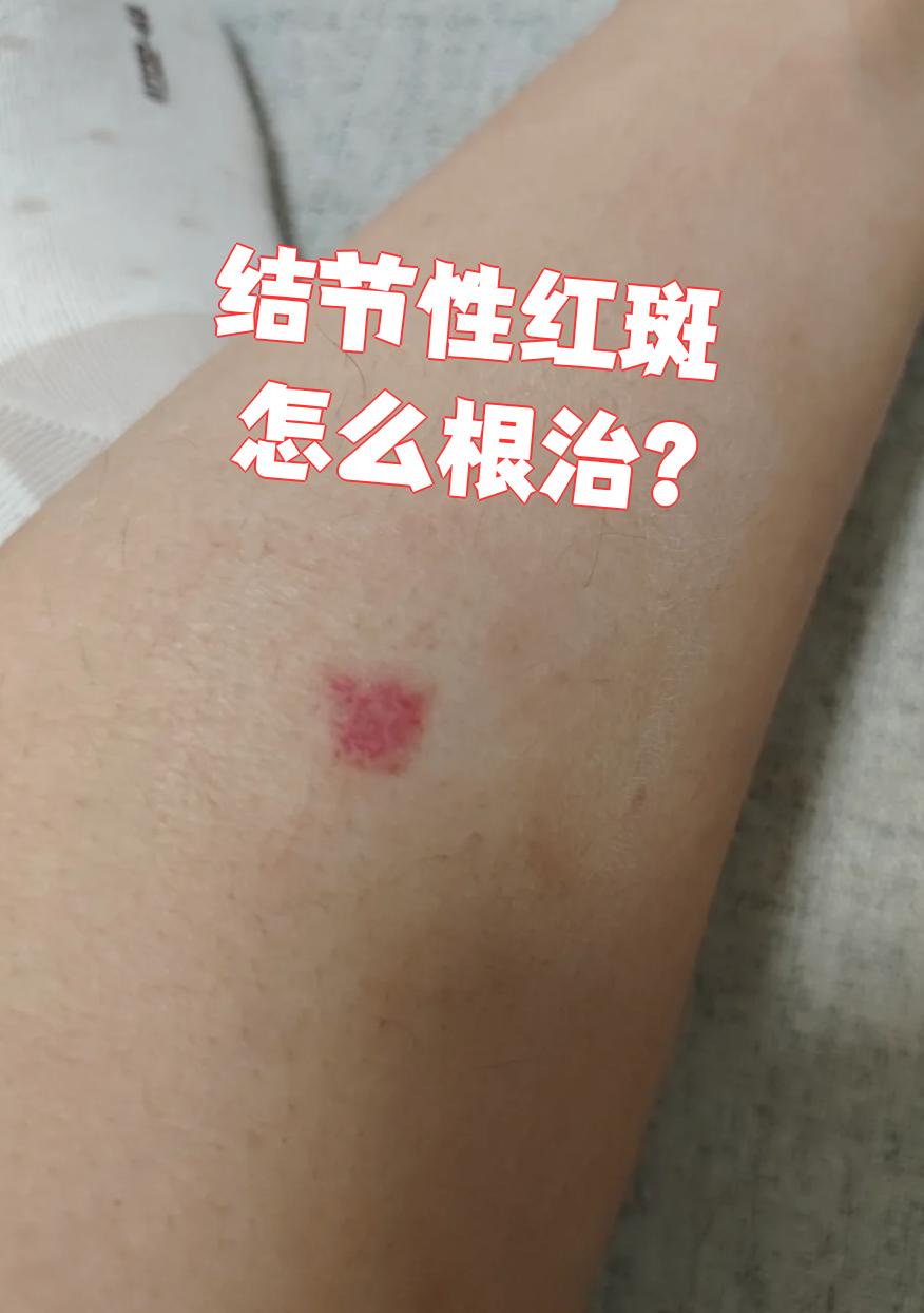 结节性红斑目前无法根治,但可以通过以下方法控制症状