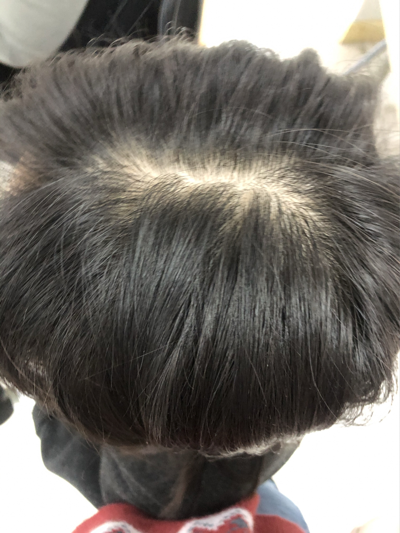 这样的头顶正常吗