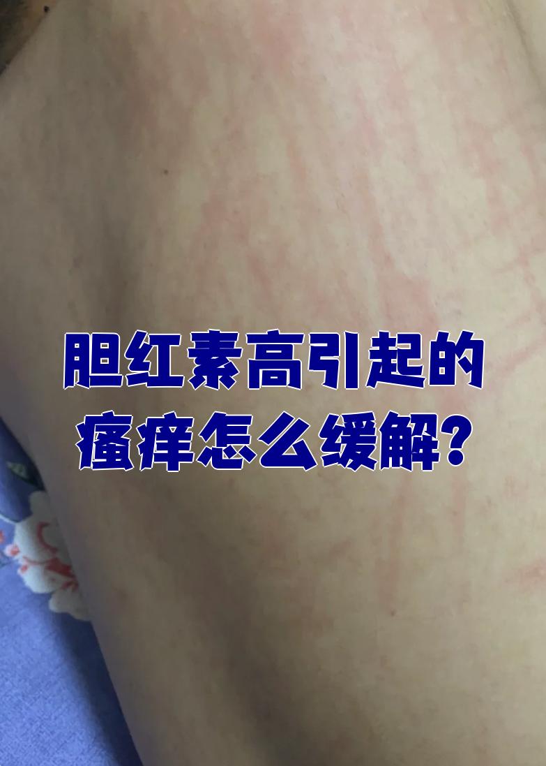 引起的瘙痒可以通过以下方法缓解: