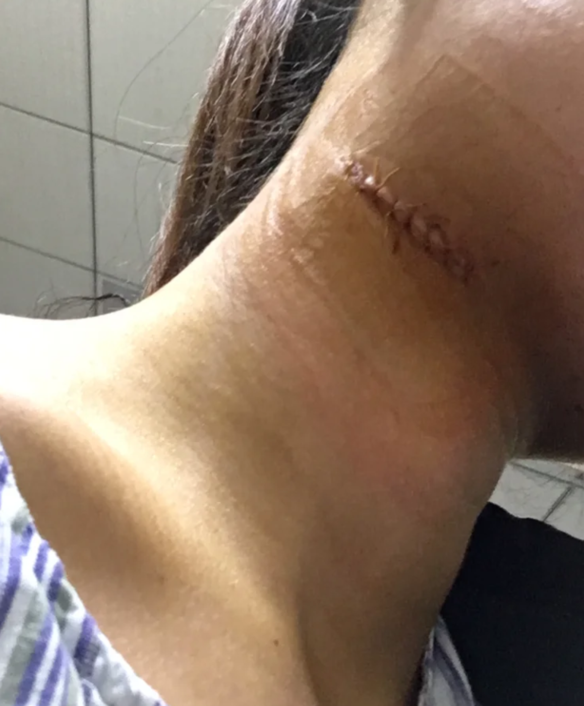 这种囊肿会慢慢压迫周围骨质,导致骨头膨胀变薄