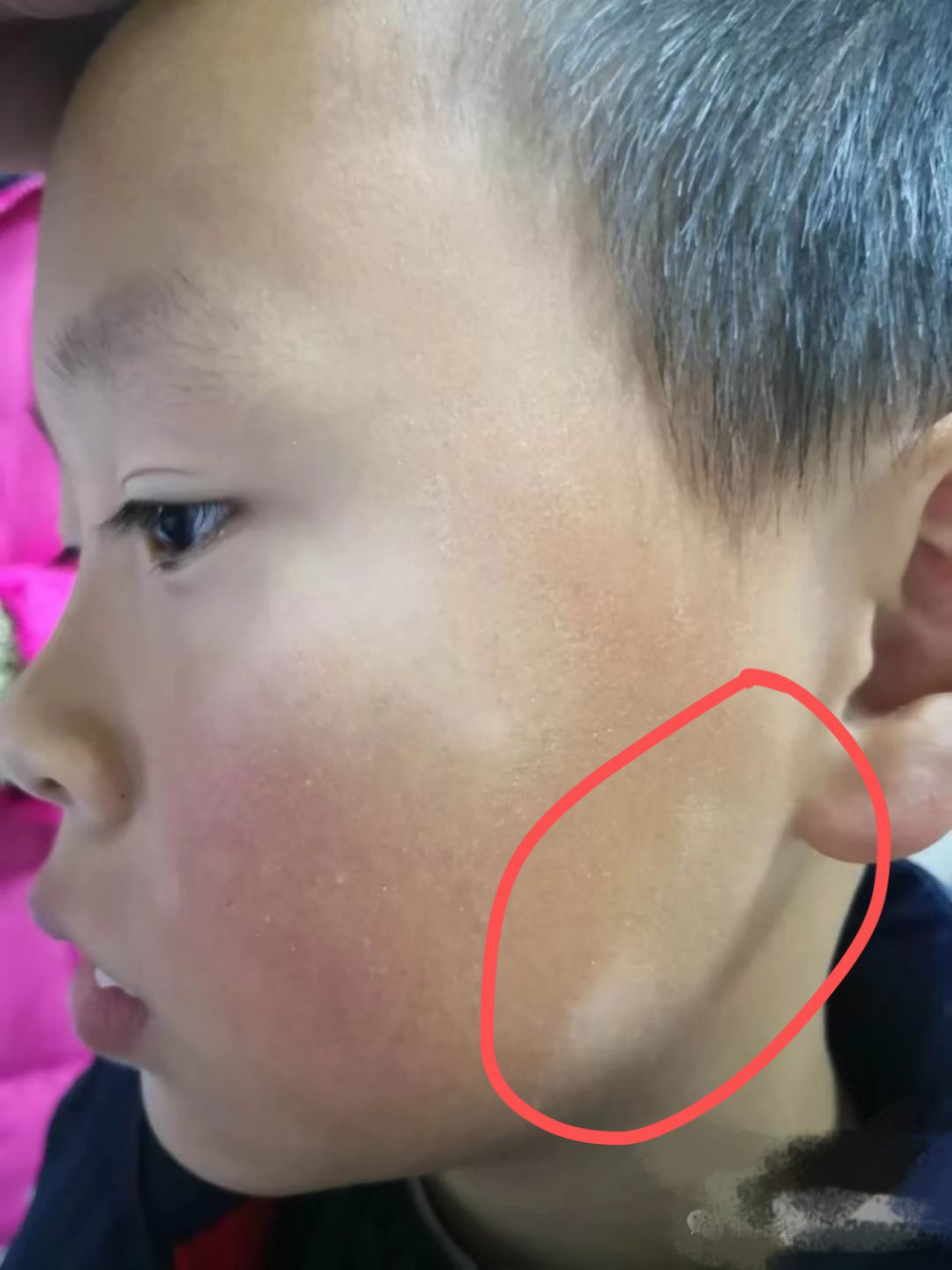 面部白斑其实之前也有说过,最近又很多问的, "我们孩子脸色突然有一块