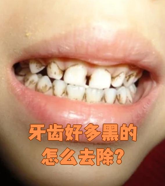 牙齿发黑最常见的原因是牙菌斑和牙结石堆积,这和平时刷牙不彻底,爱
