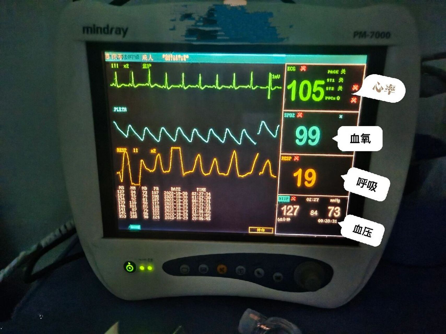 心电监护报警界限设定 心率 73正常心率(60-100次/分),无特殊情况