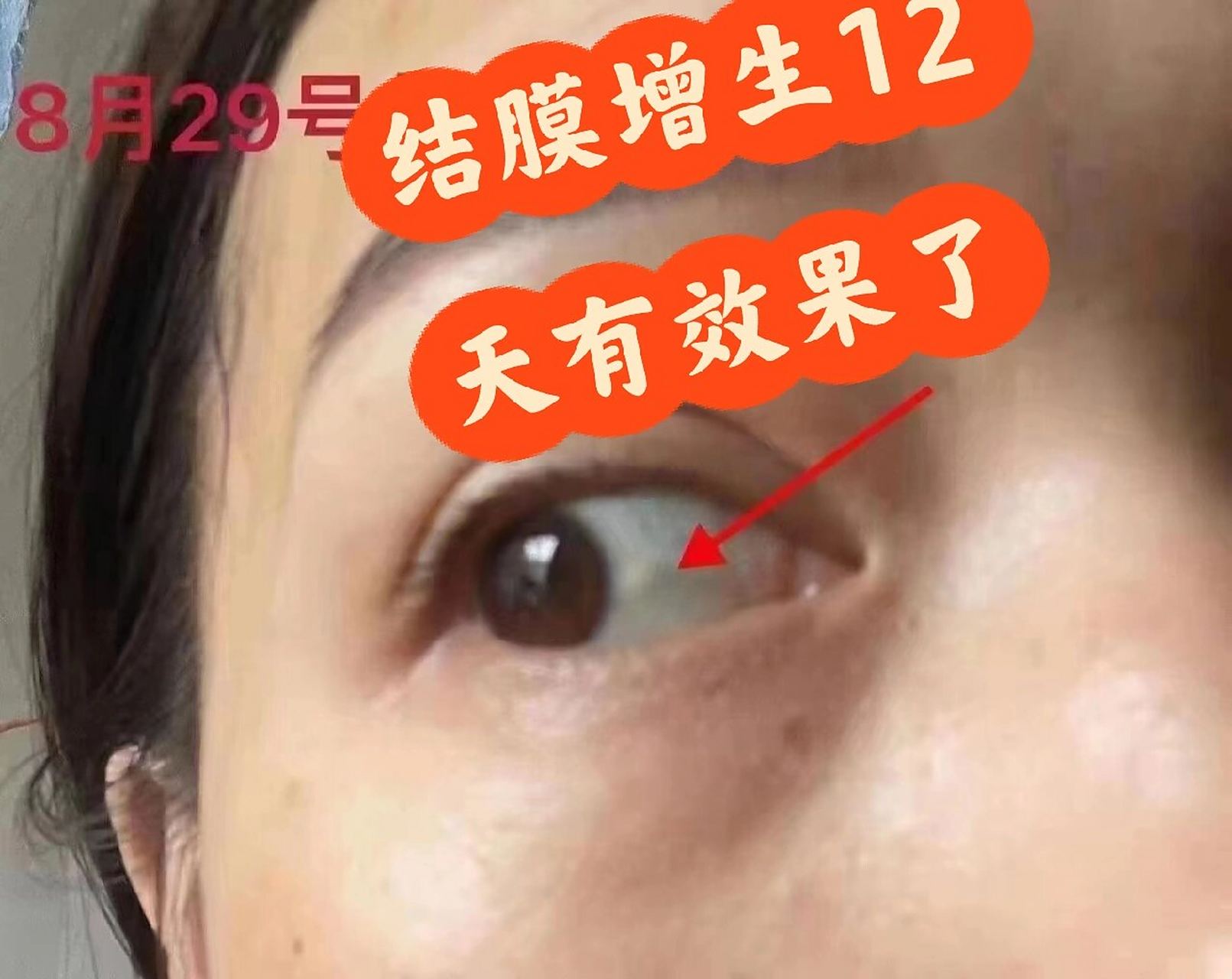 眼结膜增生十二天的效果