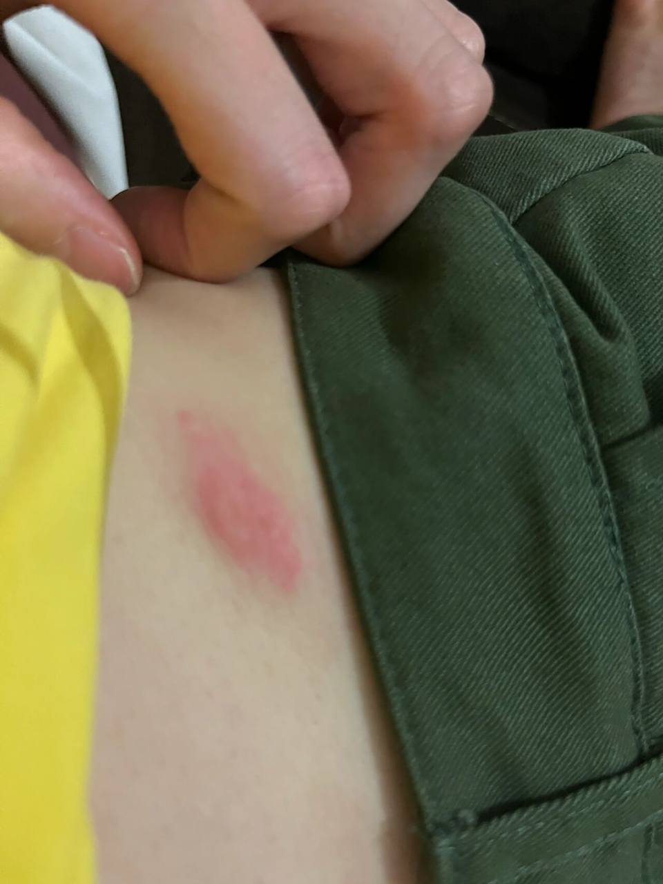 身上长了红色的大疙瘩 奇痒无比 🥺🥺 腿上身上长了5,6颗又红又肿