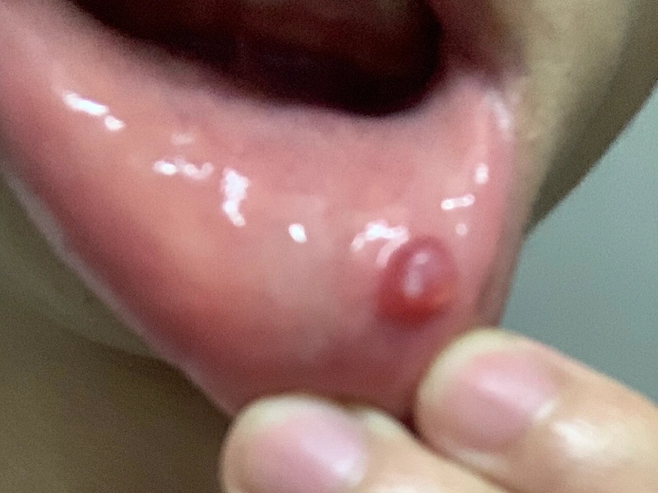 口腔粘液腺囊肿自愈过程 相信大家都被这个囊肿折磨了,本人也是