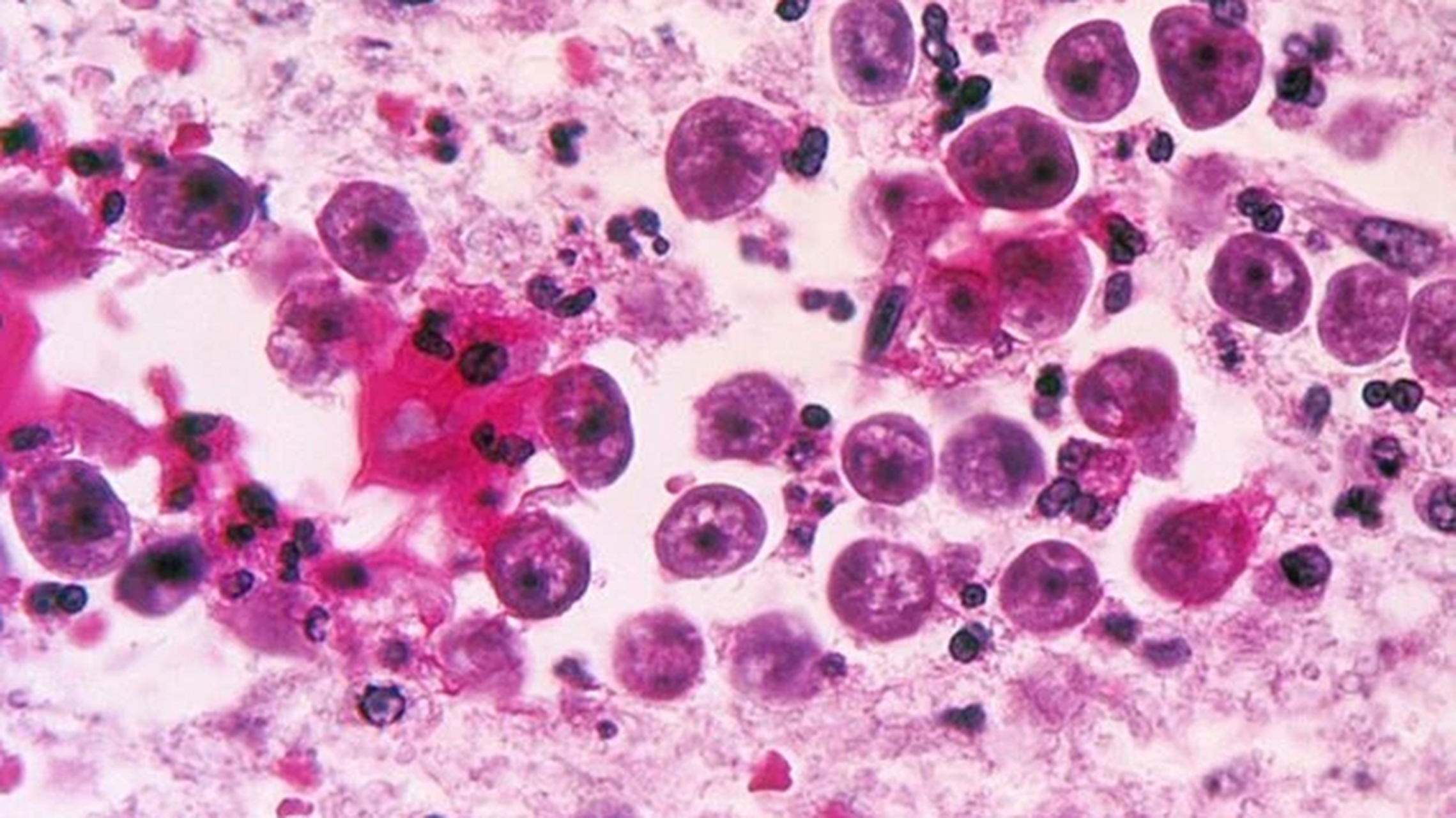 美国再现食脑虫#美国卫生官员表示,佛罗里达州出现了一例罕见"食脑虫