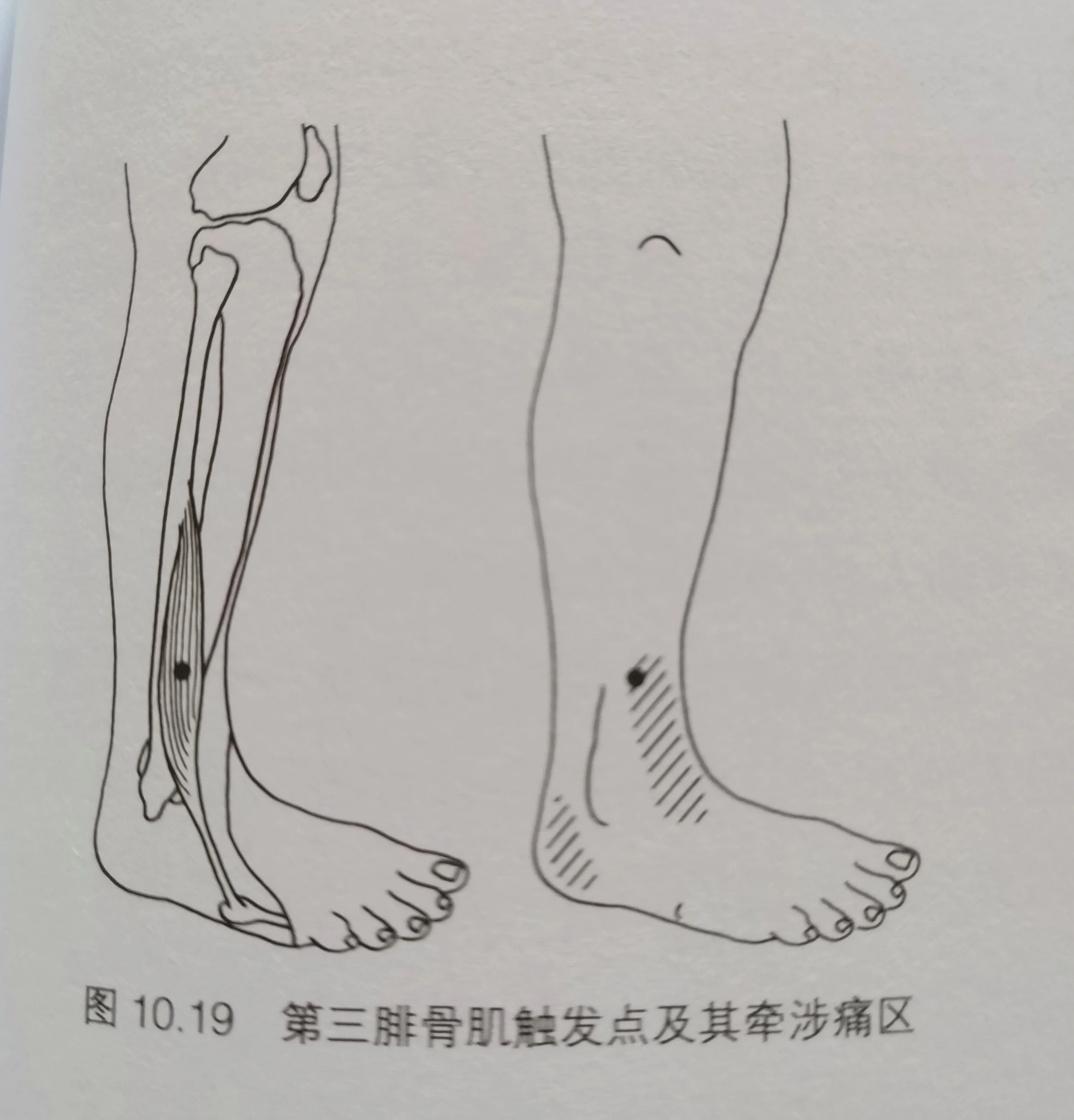 腓骨长肌起止点示意图图片