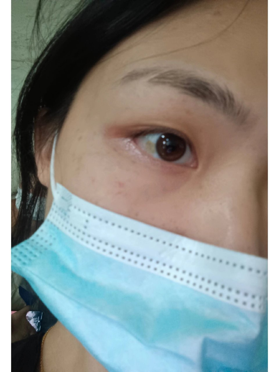 眼白色素痣 眼睛里这块色素已经很多年了,不敢跟人对视,怕别人发现,还