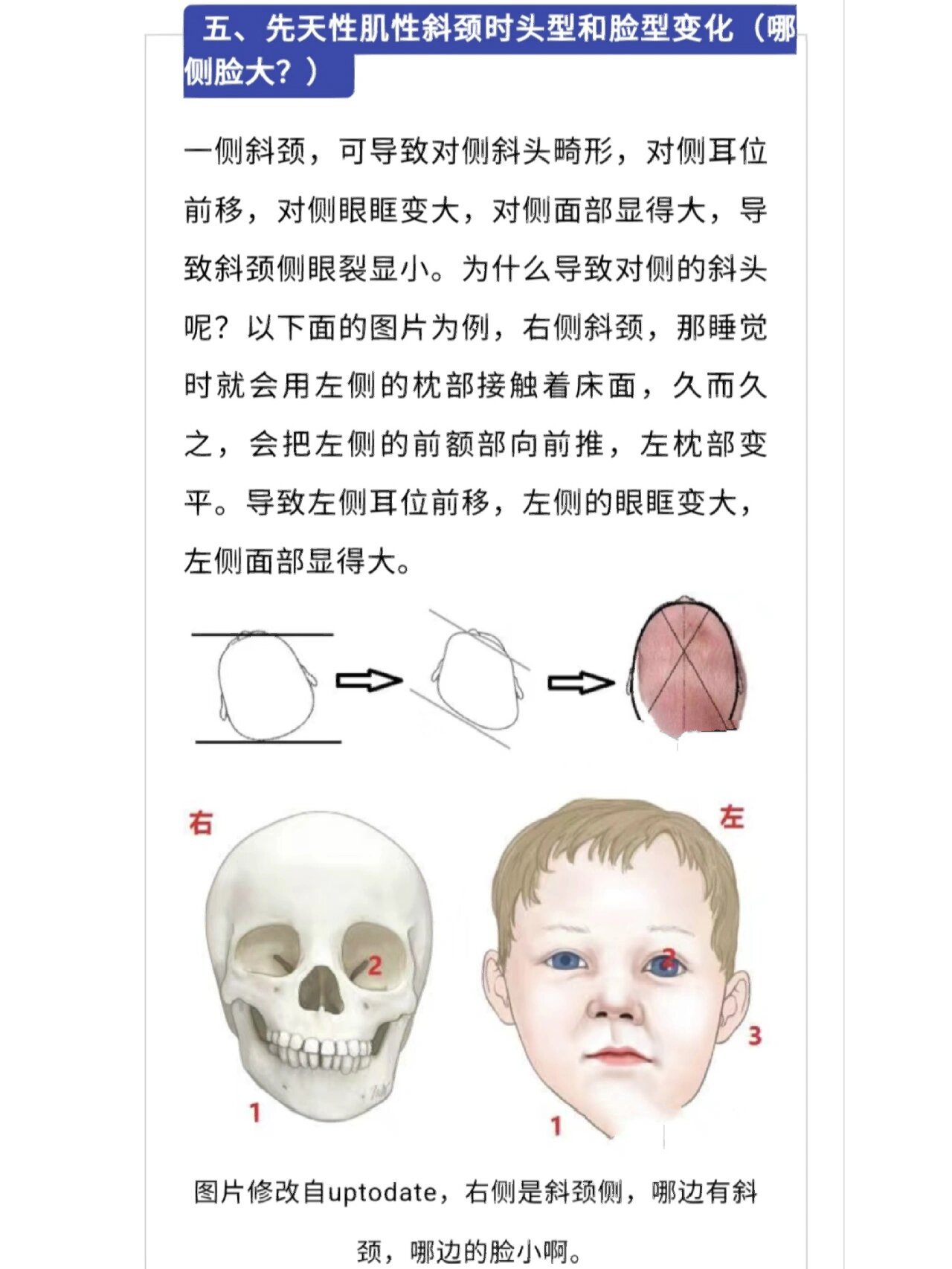 左侧斜颈图片