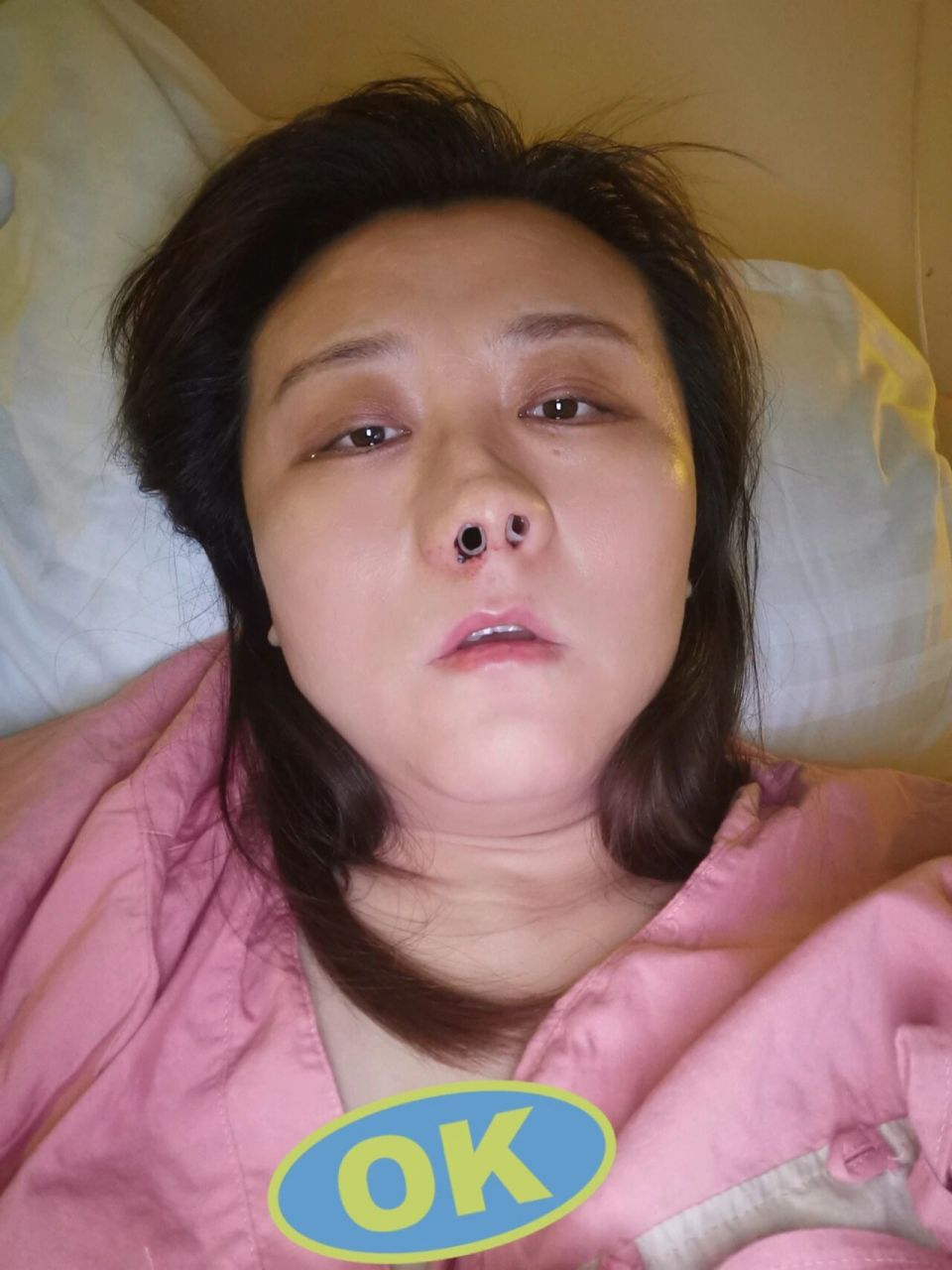 鼻中隔偏曲矫正手术 做了两天术前检查,通知我16号可以做手术了,术前
