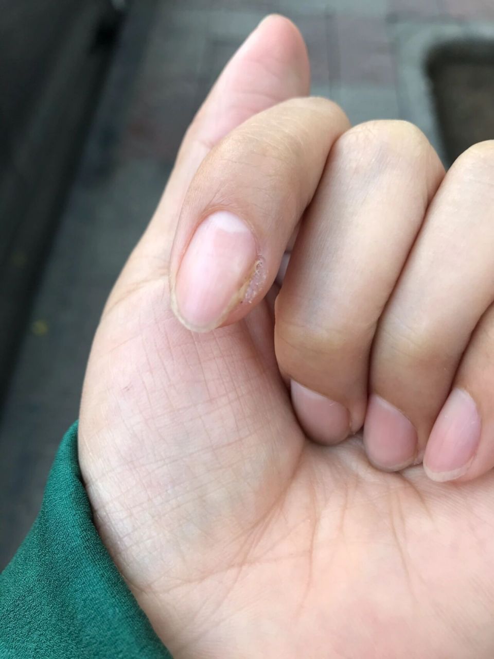 疣的疼是一想起来就瑟瑟发抖的噩梦 去年无意间发现大拇指指甲边缘长