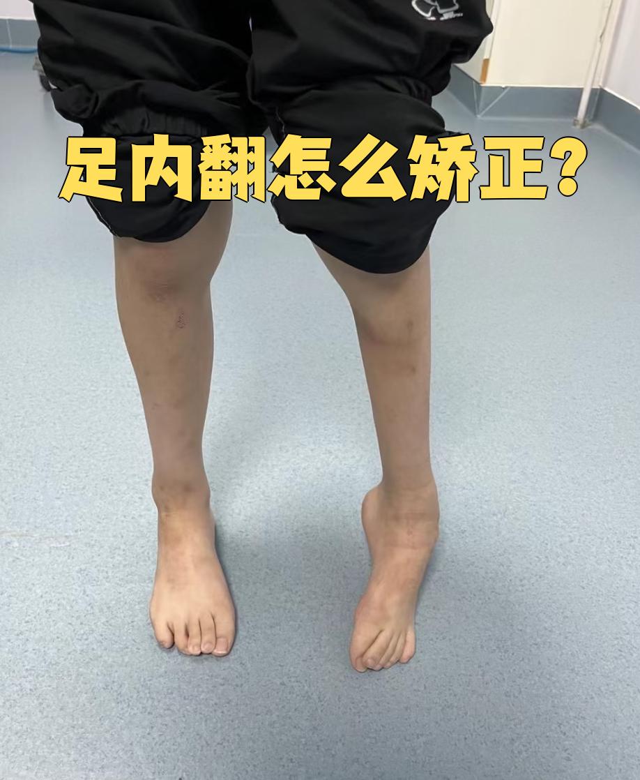足内翻通常指的是先天性马蹄内翻足,这是小儿常见的足部畸形,会沿重