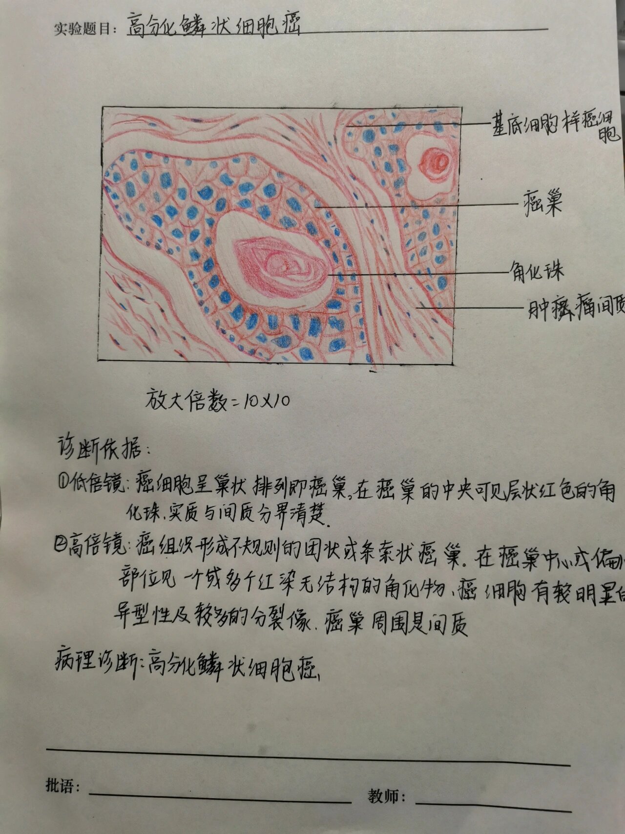 鳞状细胞癌绘图图片