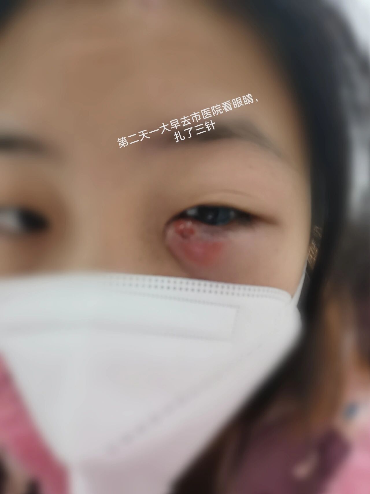 麦粒肿治疗全过程 家人们,我的眼睛现在已经好的差不多了,感谢网友给