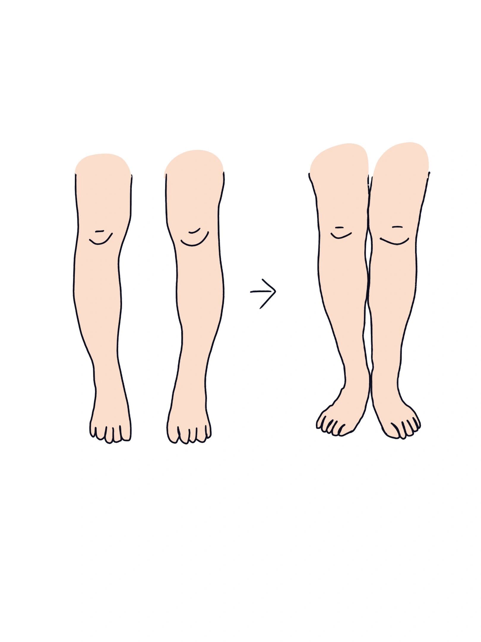 "o"型腿在医学上称为膝内翻,指的是在膝关节处,小腿的胫93向内旋转