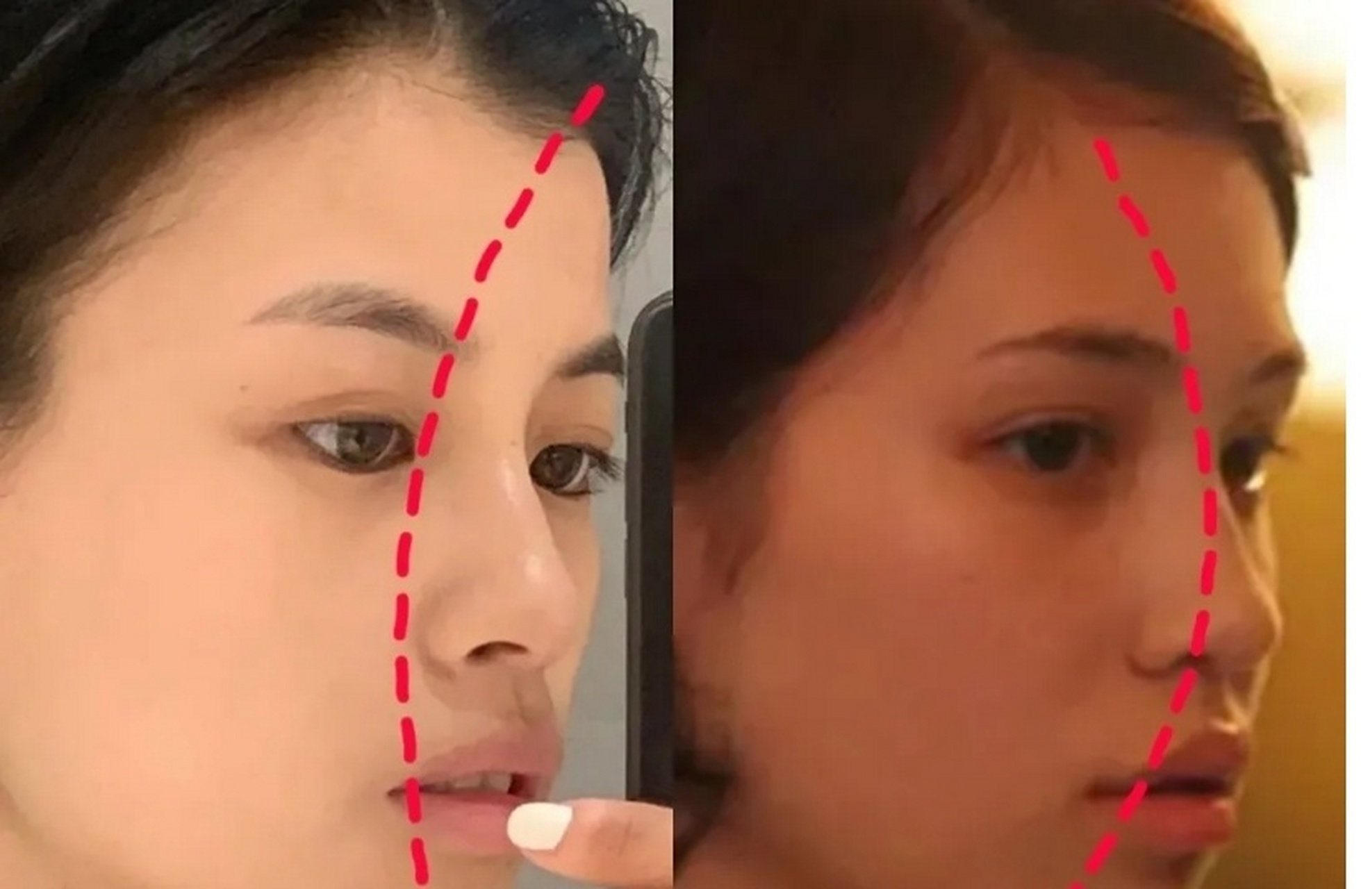 对于金敏喜来说,鼻基底虽然凹陷但五官整体还是很协调的,并不用门着