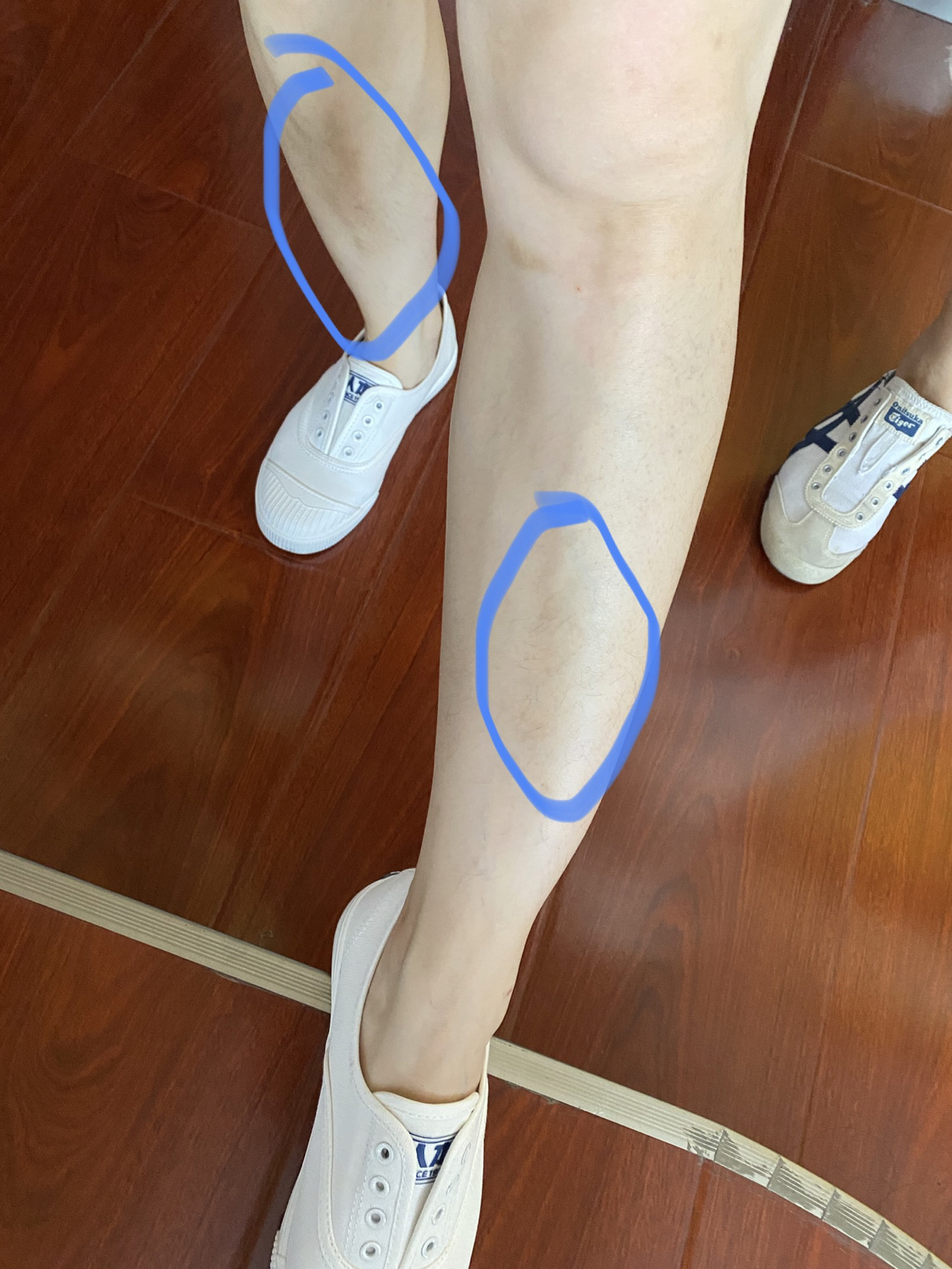 小腿正前方中间位置发黑求解答