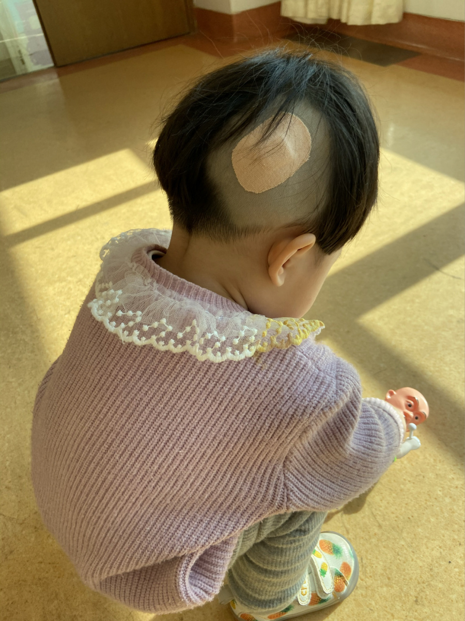 出生头上长了一个疙瘩,医生称为皮下囊肿 宝宝出生