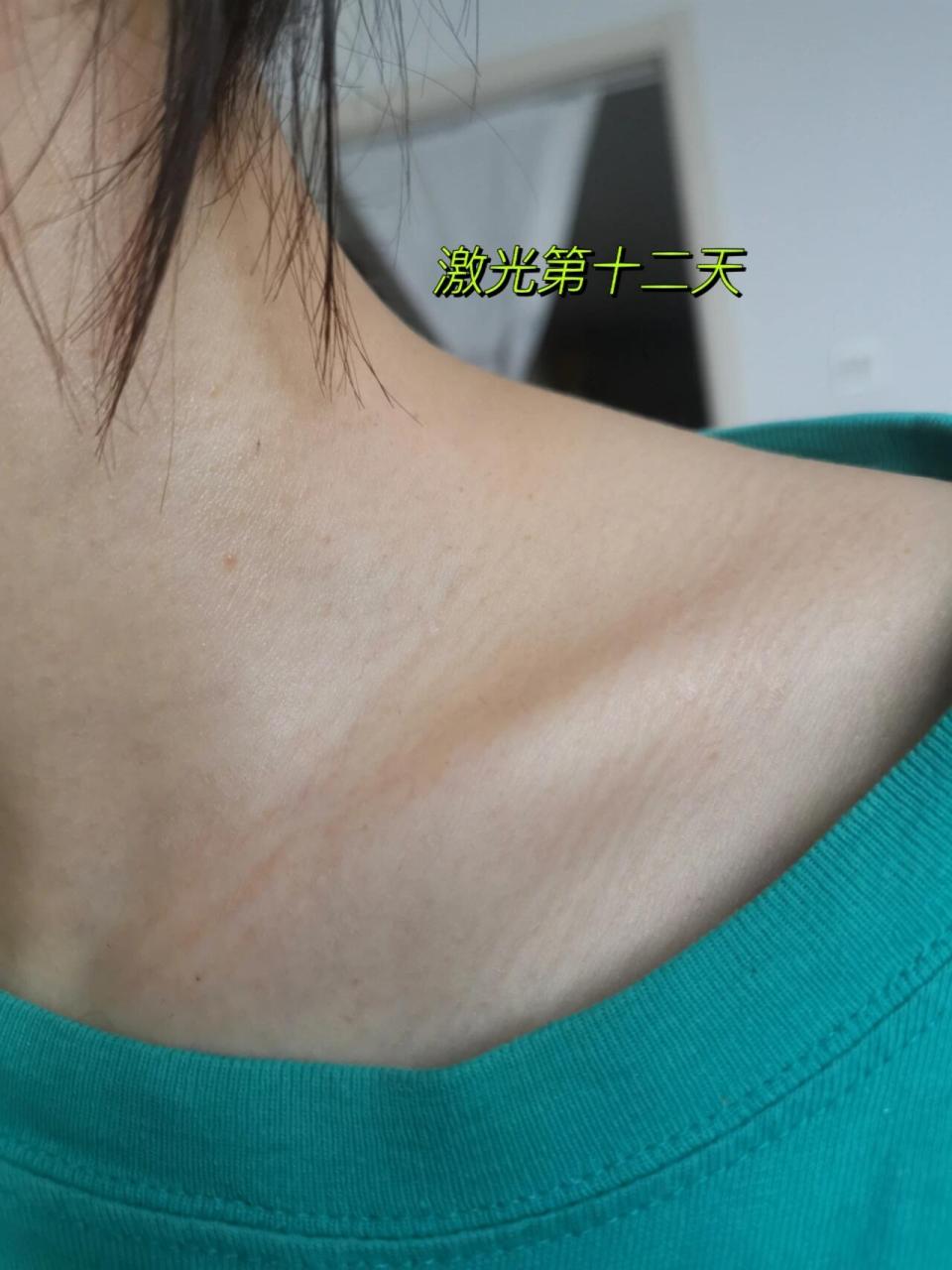 301医院激光去丝状疣 右滑就能看到激光12天后的样子 16615 年前