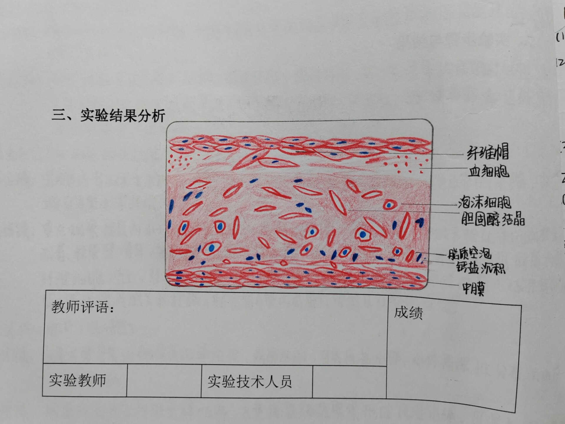 红蓝铅笔绘图之病理动脉粥样硬化 心血管系统疾病