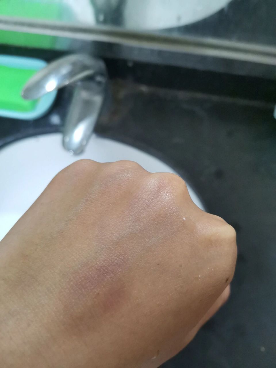 挂水挂的手都青了呜呜呜 前几天感冒了  去医院挂水 结果过几天再看看