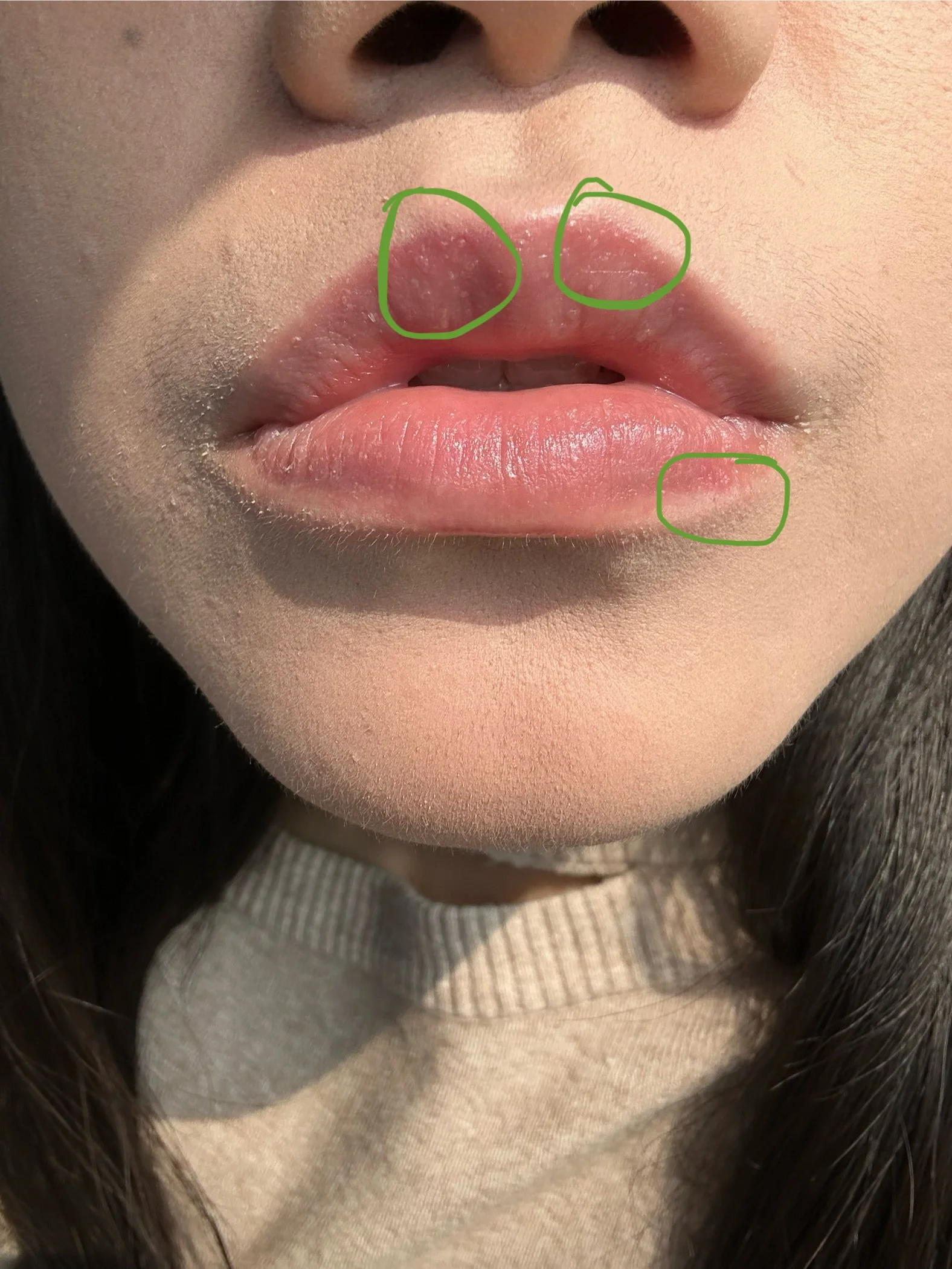 太阳光底下的嘴 涂的凡士林 嘴唇边缘还是有小水泡天天有也消不下去我