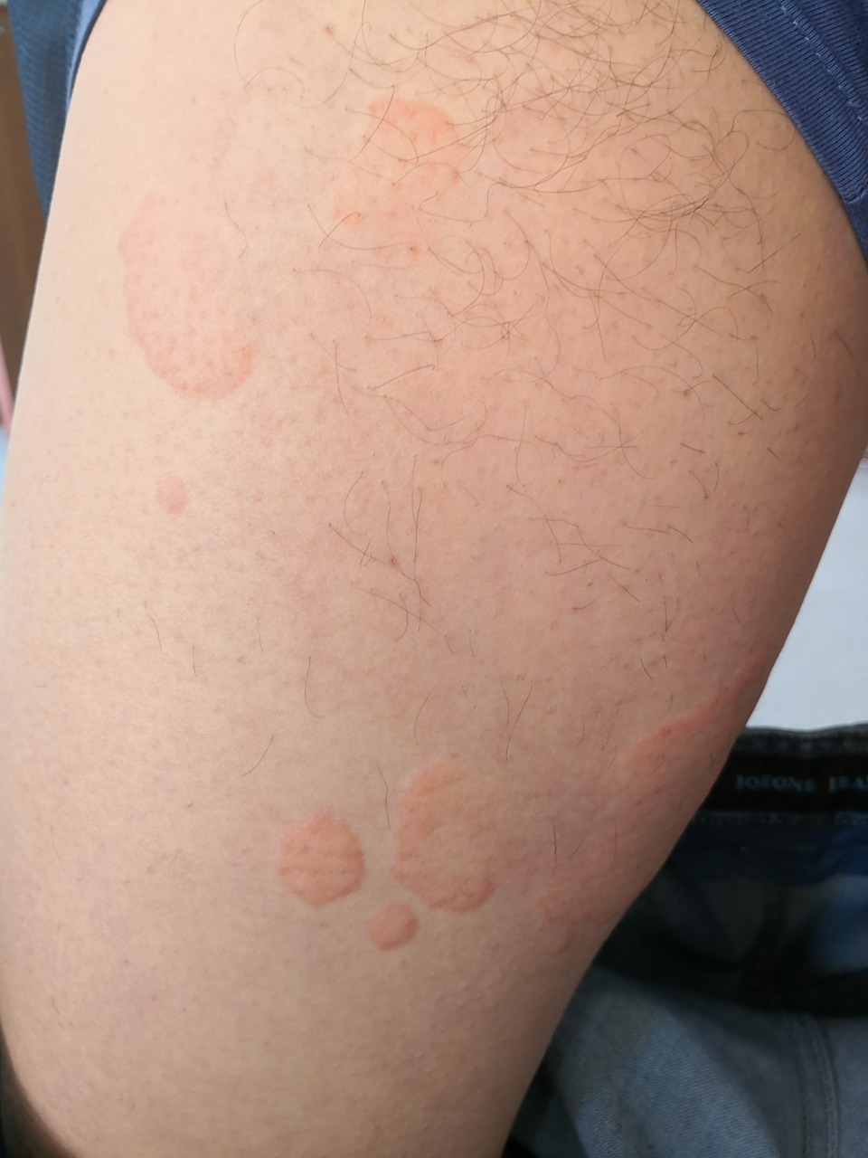 是急性荨麻疹典型症状.#解决皮肤问题专注皮肤美容##过敏