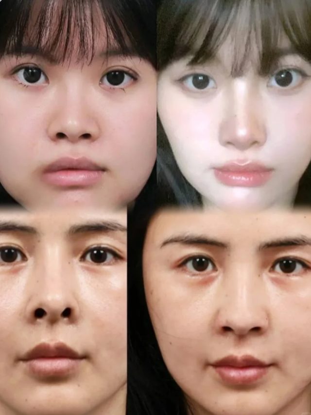 鼻孔外露其实就是你的鼻翼缘后缩,鼻翼缘后缩的主要原因主要有: 1