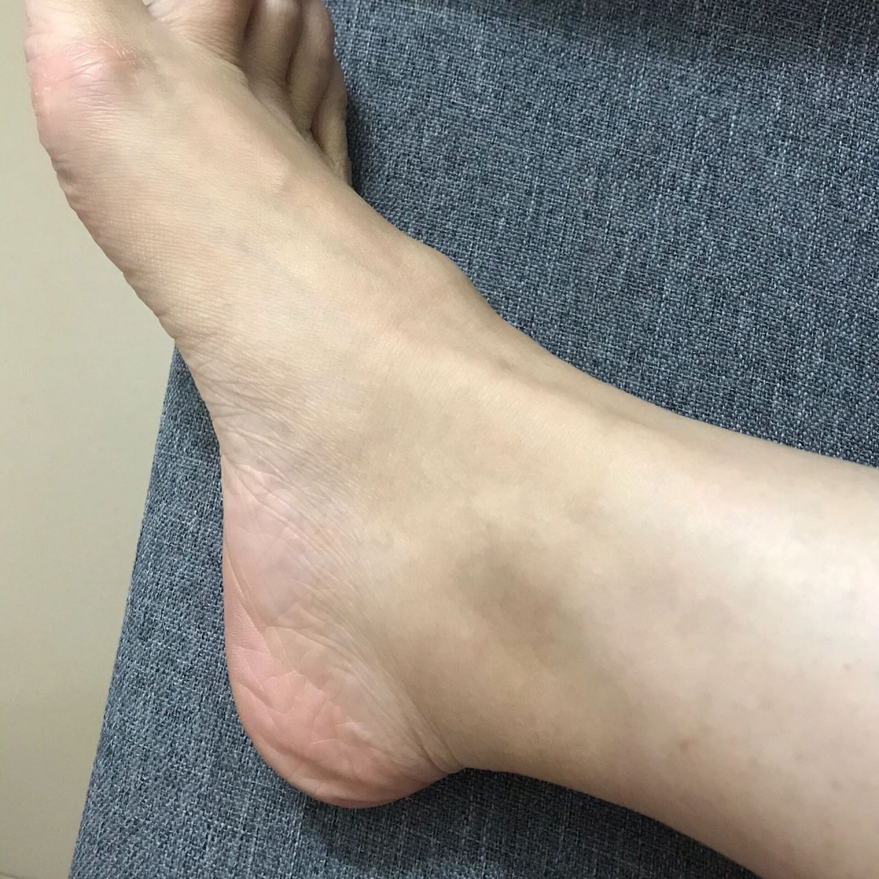 脚背鼓包 就挺突然的 摁的话有点疼 不摁就不疼 这是个什么鬼?