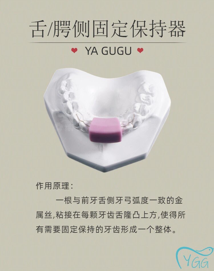 今日学习:舌/腭侧固定保持器