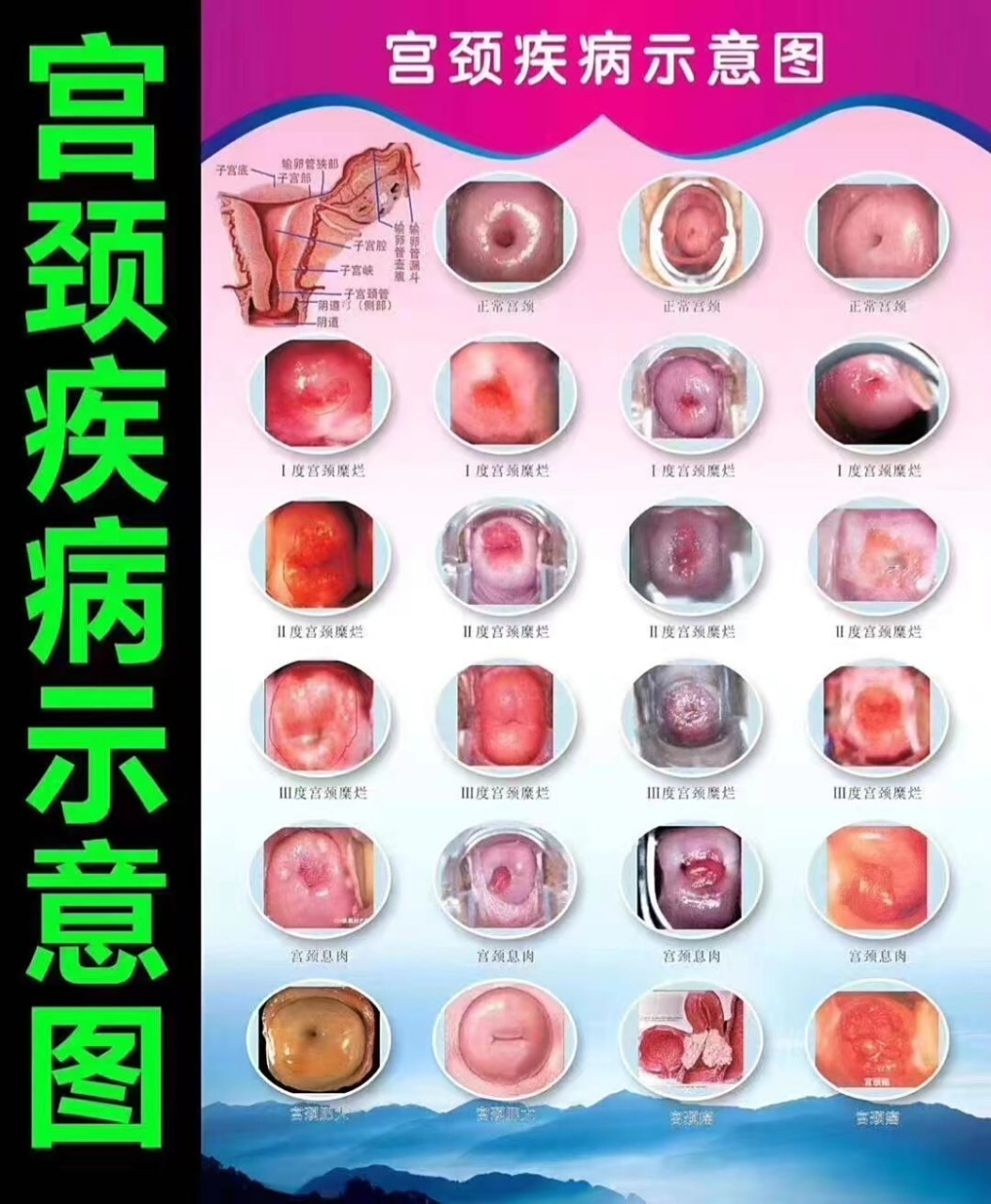 最全宫颈疾病示意图 98 98 不要觉得可怕,不要觉得恶心,这就是