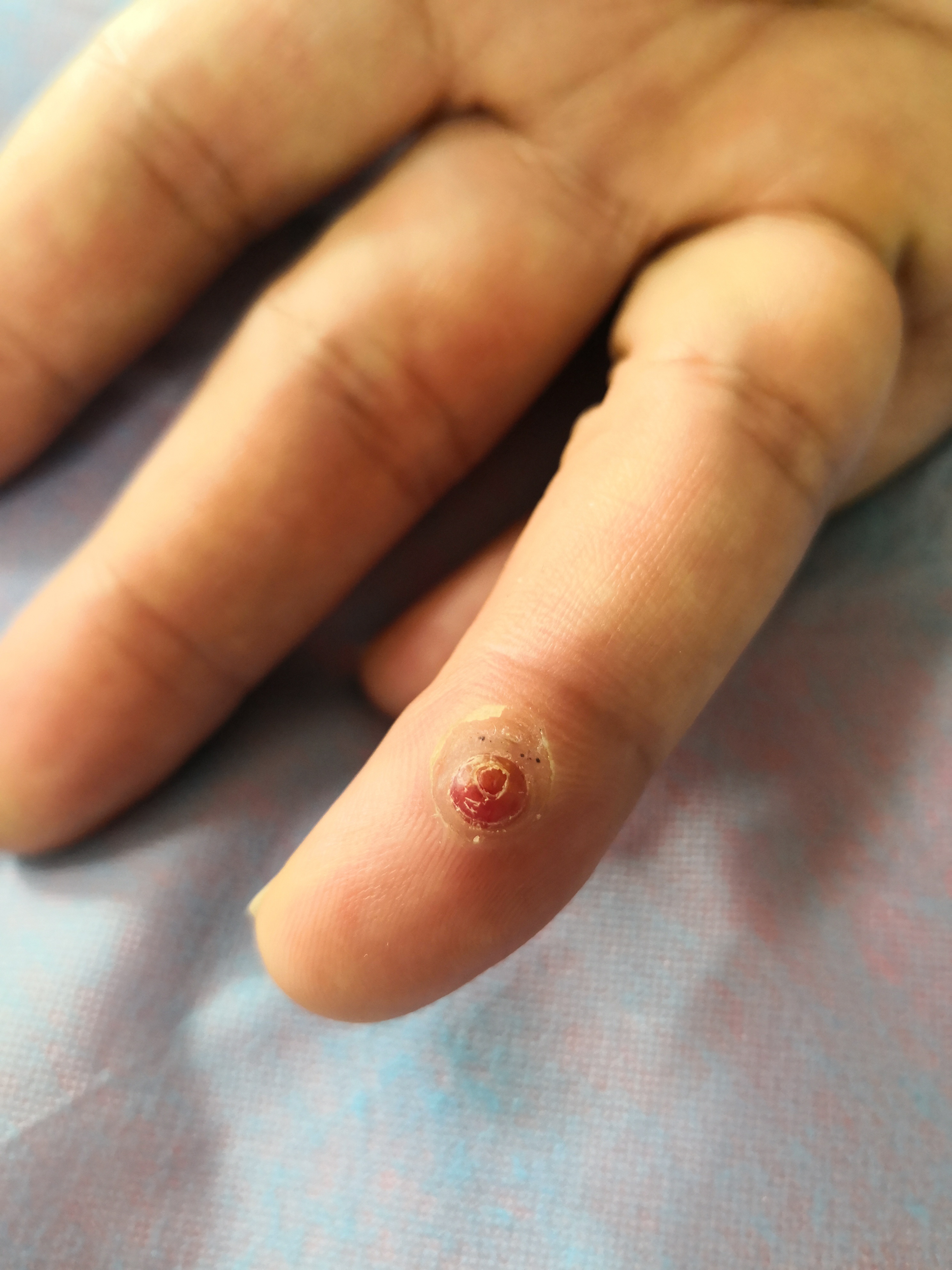 可以使用激光治疗配合药物治疗.#解决皮肤问题专注皮肤美容##肉芽肿