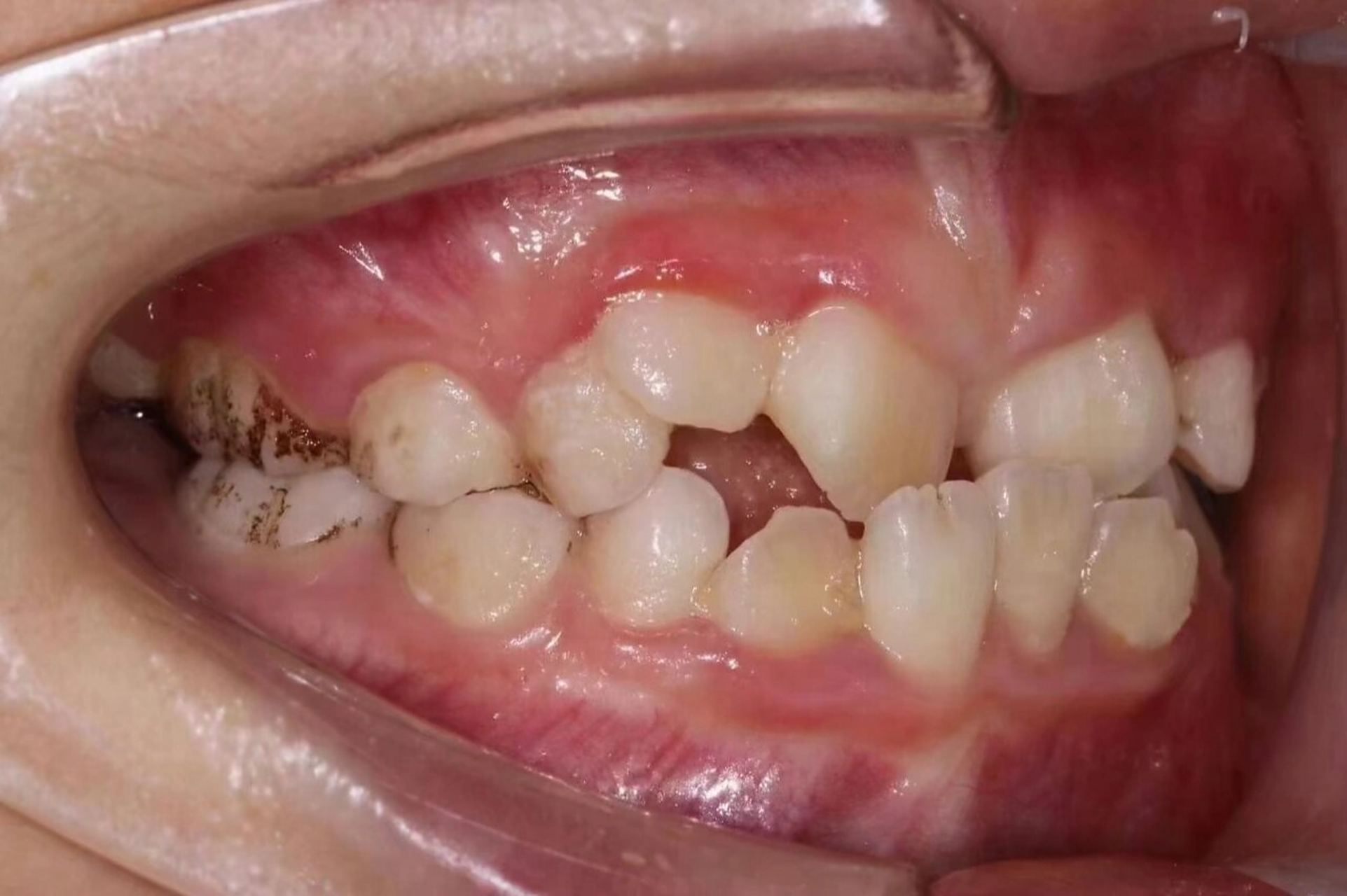 小朋友的牙齿不仅拥挤凌乱还反颌地包天,而且牙齿也存在各种方向扭转