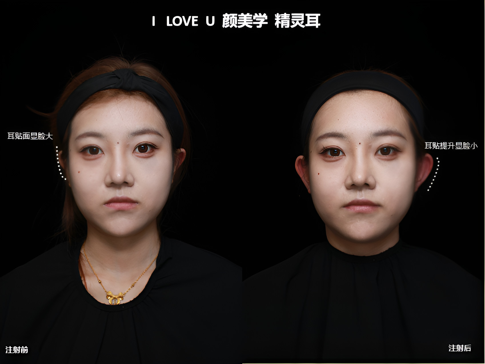 精灵耳注射美容显脸小立体 一直以来都觉得自己的耳朵不够出彩,直到