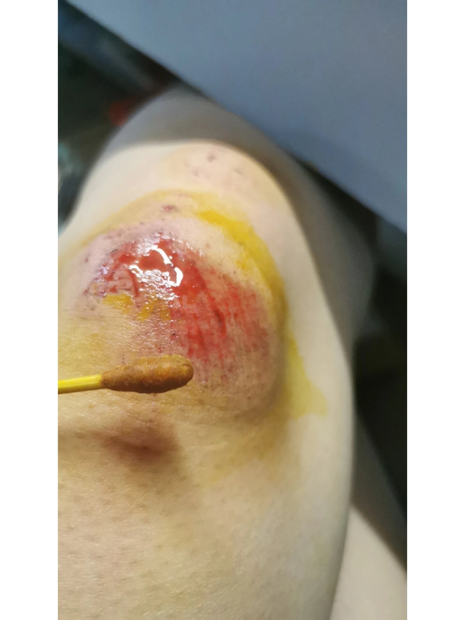 骑电动车膝盖摔伤第6天😭慎点