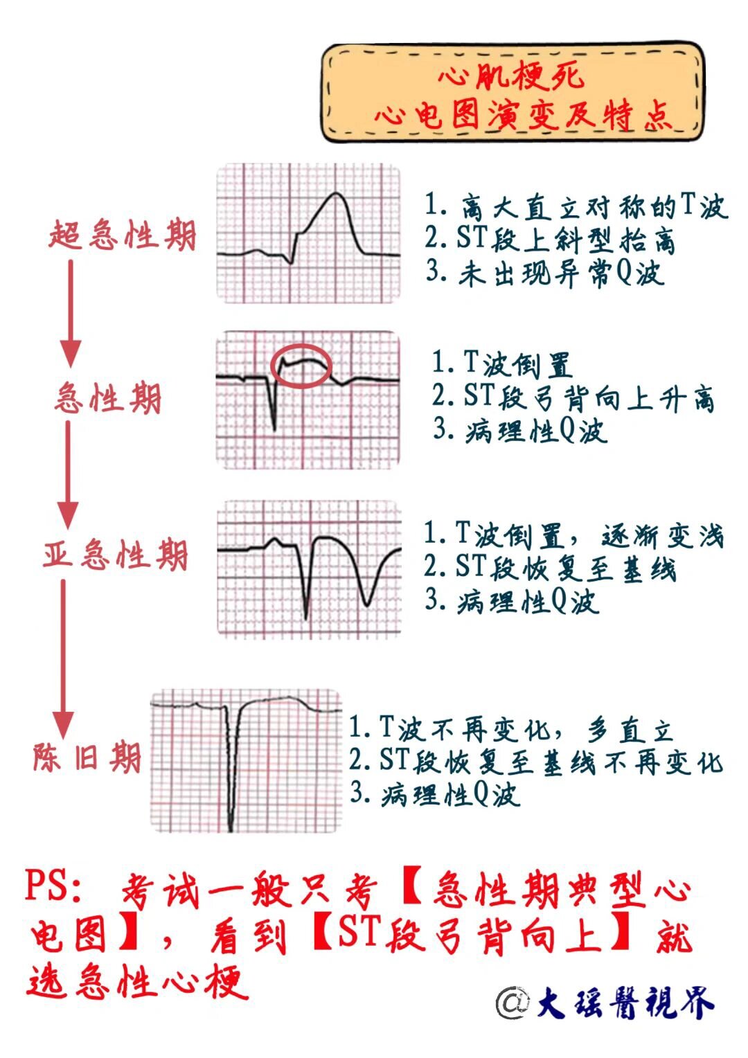 心梗位置判断 图图片