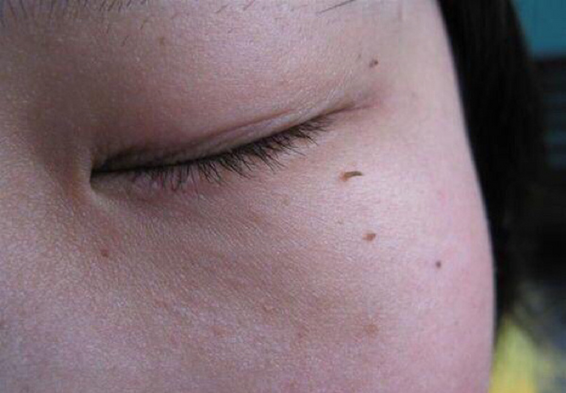 眼周这种小疙瘩要警惕,有可能是hpv阳性感 眼睛也是会感染hpv病毒的