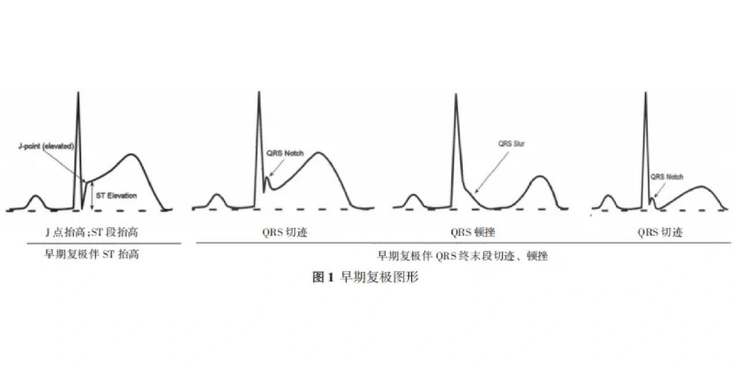 早期复极心电图图片